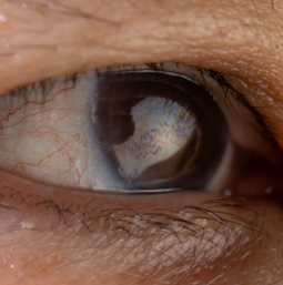 Cataract Surgery Consultation