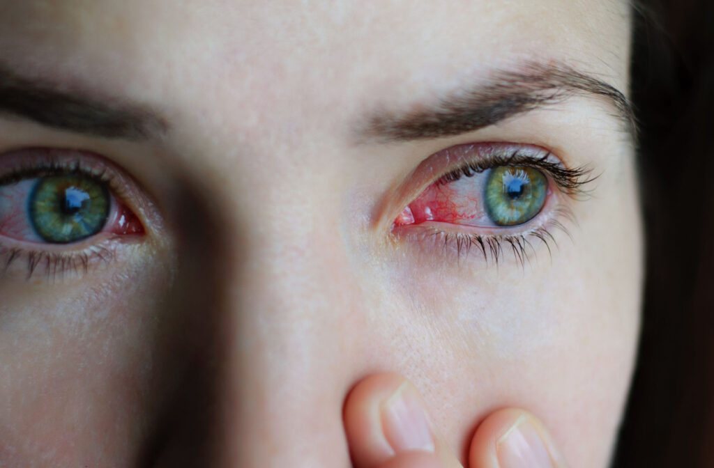 A close-up of a person's eyes with redness caused by conjunctivitis.